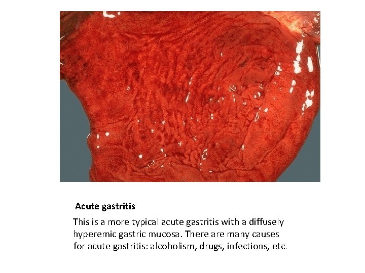 Acute gastritis This is a more typical acute gastritis with a diffusely hyperemic gastric