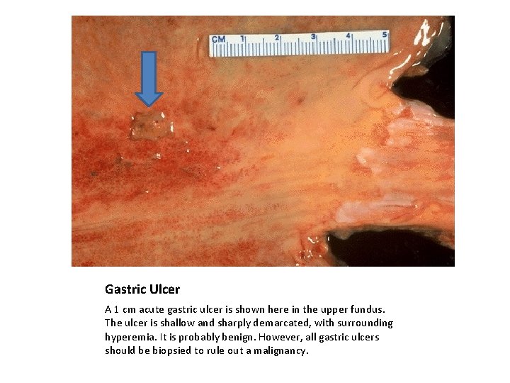 Gastric Ulcer A 1 cm acute gastric ulcer is shown here in the upper
