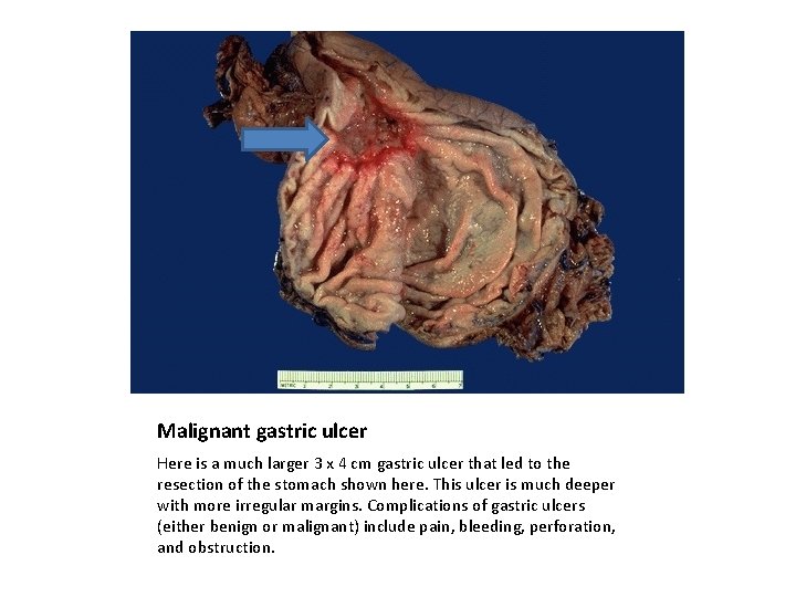 Malignant gastric ulcer Here is a much larger 3 x 4 cm gastric ulcer