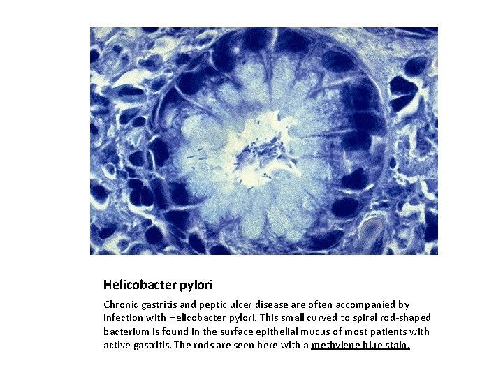 Helicobacter pylori Chronic gastritis and peptic ulcer disease are often accompanied by infection with