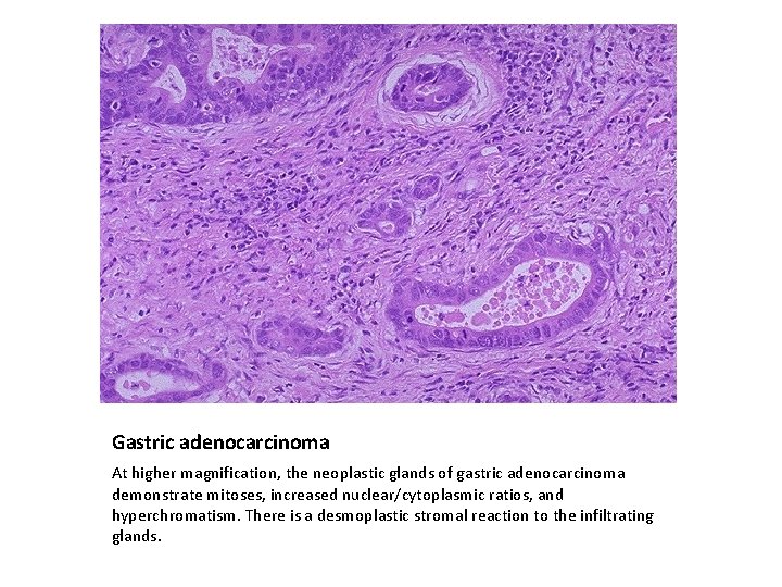 Gastric adenocarcinoma At higher magnification, the neoplastic glands of gastric adenocarcinoma demonstrate mitoses, increased