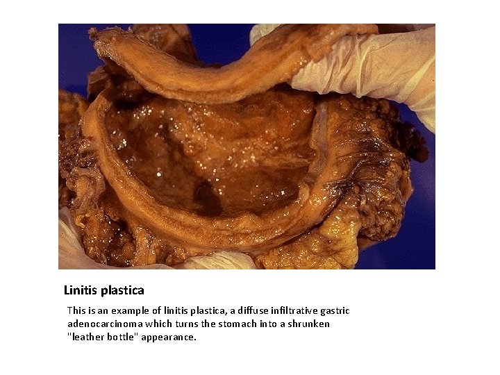 Linitis plastica This is an example of linitis plastica, a diffuse infiltrative gastric adenocarcinoma