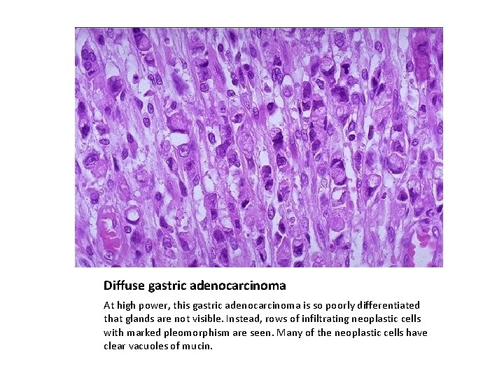 Diffuse gastric adenocarcinoma At high power, this gastric adenocarcinoma is so poorly differentiated that