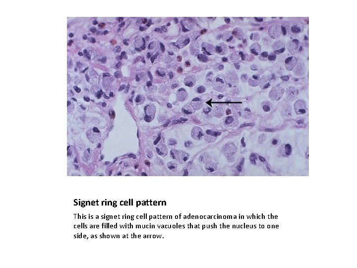 Signet ring cell pattern This is a signet ring cell pattern of adenocarcinoma in