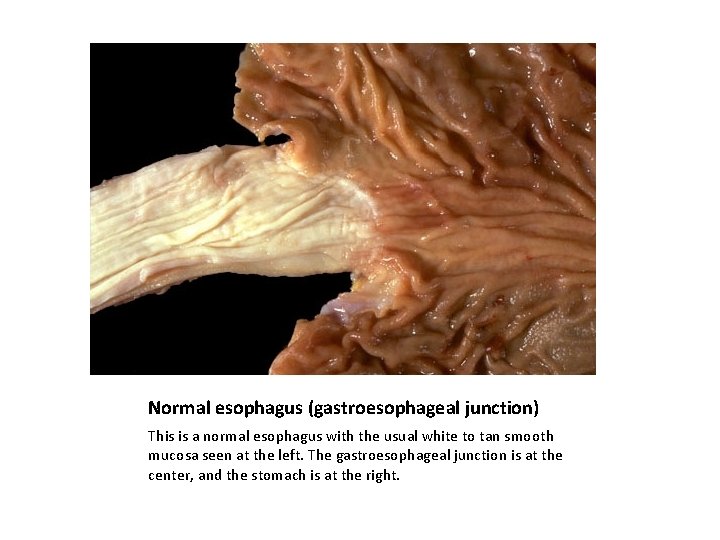 Normal esophagus (gastroesophageal junction) This is a normal esophagus with the usual white to