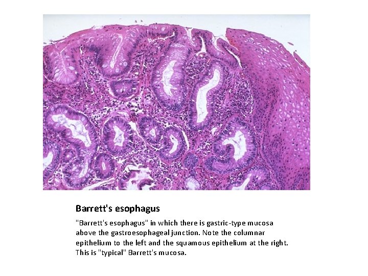 Barrett's esophagus "Barrett's esophagus" in which there is gastric-type mucosa above the gastroesophageal junction.