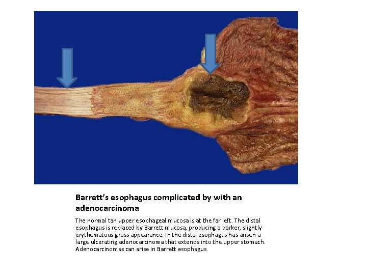Barrett’s esophagus complicated by with an adenocarcinoma The normal tan upper esophageal mucosa is