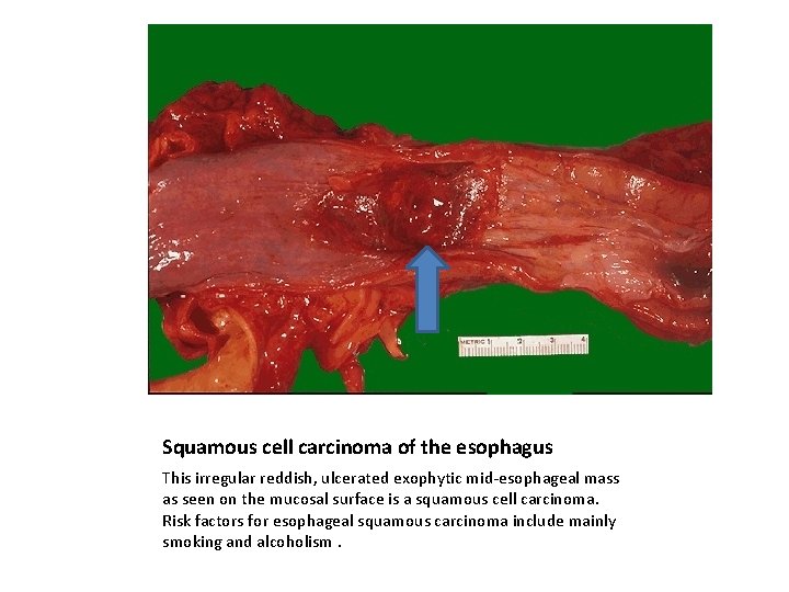 Squamous cell carcinoma of the esophagus This irregular reddish, ulcerated exophytic mid-esophageal mass as