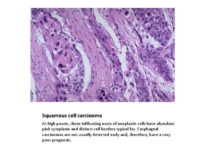 Squamous cell carcinoma At high power, these infiltrating nests of neoplastic cells have abundant