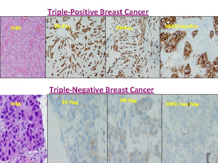 Triple-Positive Breast Cancer H&E ER-Pos PR-Pos HER 2/neu-Pos Triple-Negative Breast Cancer H&E ER-Neg PR-Neg