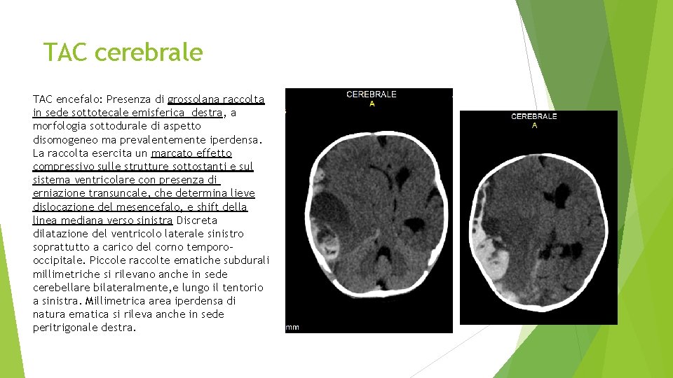 TAC cerebrale TAC encefalo: Presenza di grossolana raccolta in sede sottotecale emisferica destra, a