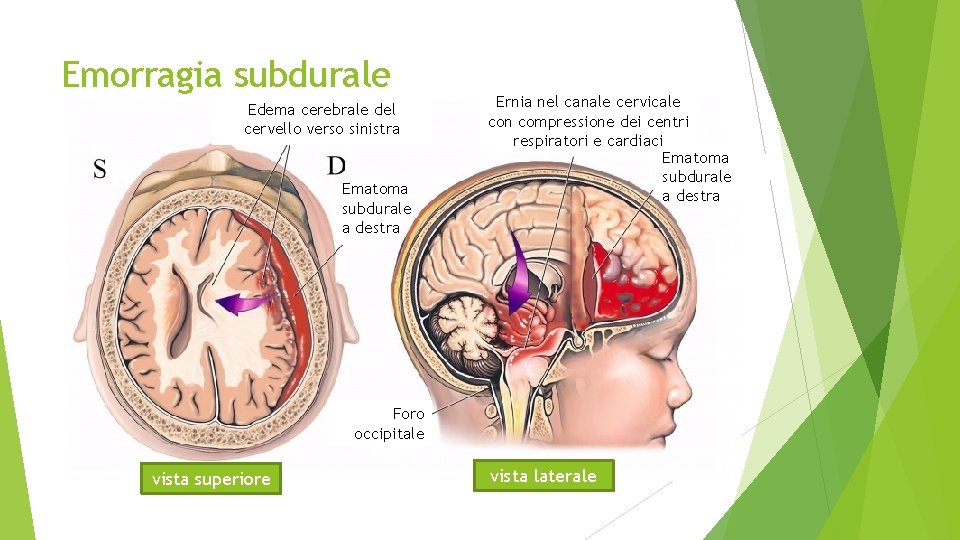 Emorragia subdurale Edema cerebrale del cervello verso sinistra Ematoma subdurale a destra Ernia nel