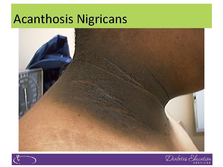 Acanthosis Nigricans 