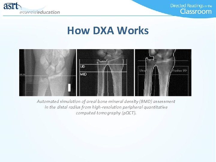 How DXA Works Automated simulation of areal bone mineral density (BMD) assessment in the