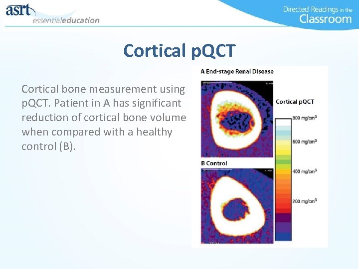 Cortical p. QCT Cortical bone measurement using p. QCT. Patient in A has significant