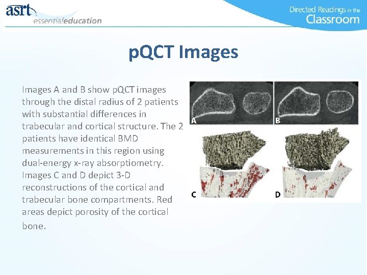 p. QCT Images A and B show p. QCT images through the distal radius