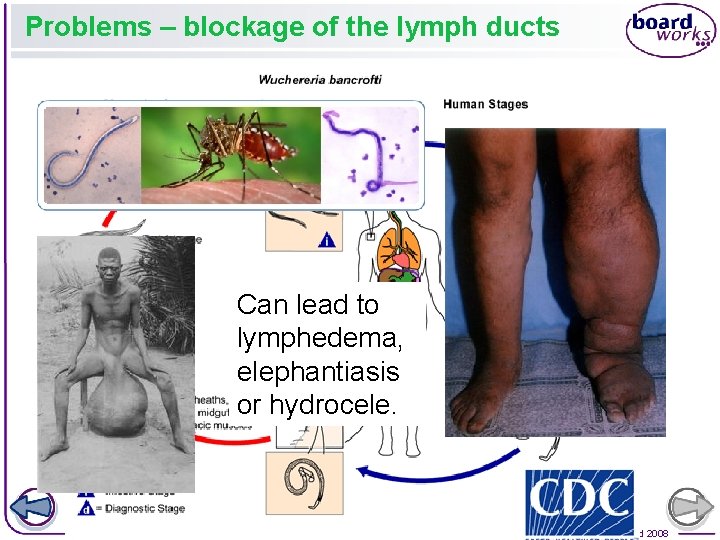 Problems – blockage of the lymph ducts Can lead to lymphedema, elephantiasis or hydrocele.