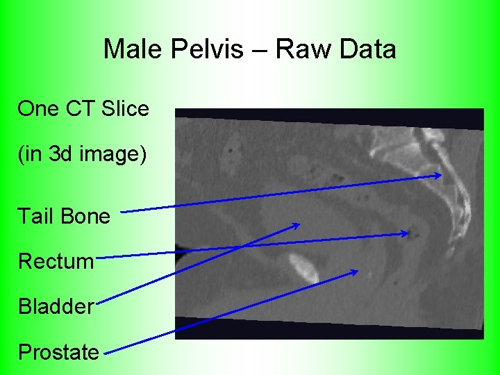 Male Pelvis – Raw Data One CT Slice (in 3 d image) Tail Bone