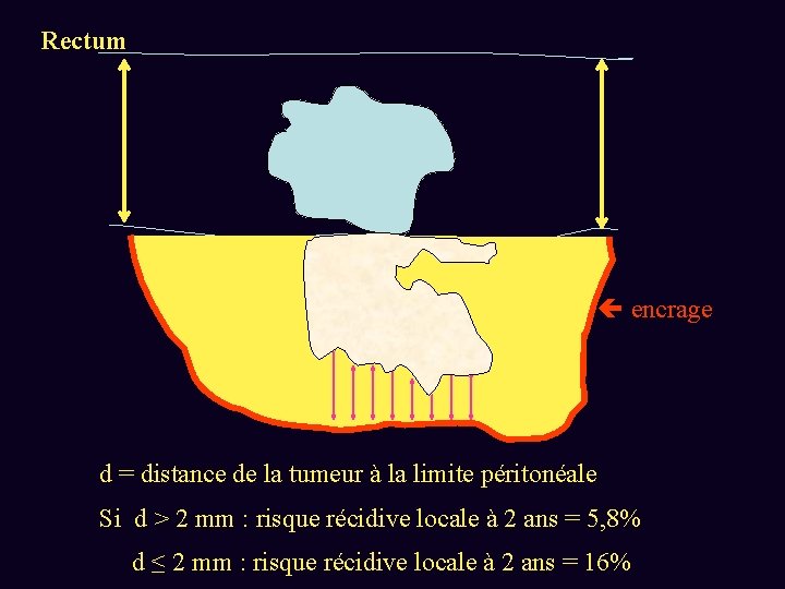 Rectum encrage d d = distance de la tumeur à la limite péritonéale Si