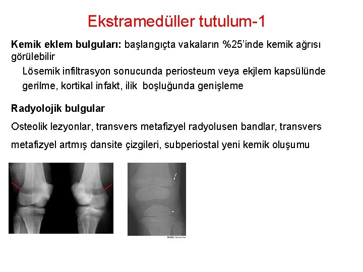Ekstramedüller tutulum-1 Kemik eklem bulguları: başlangıçta vakaların %25’inde kemik ağrısı görülebilir Lösemik infiltrasyon sonucunda