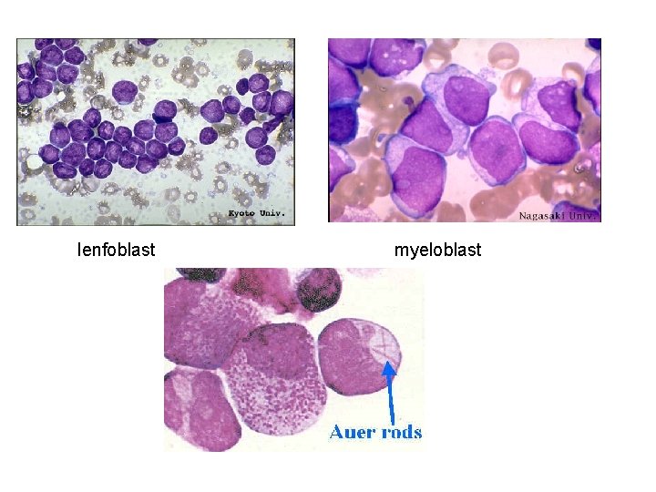 lenfoblast myeloblast 