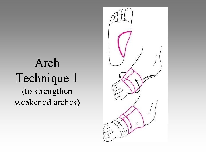 Arch Technique 1 (to strengthen weakened arches) 