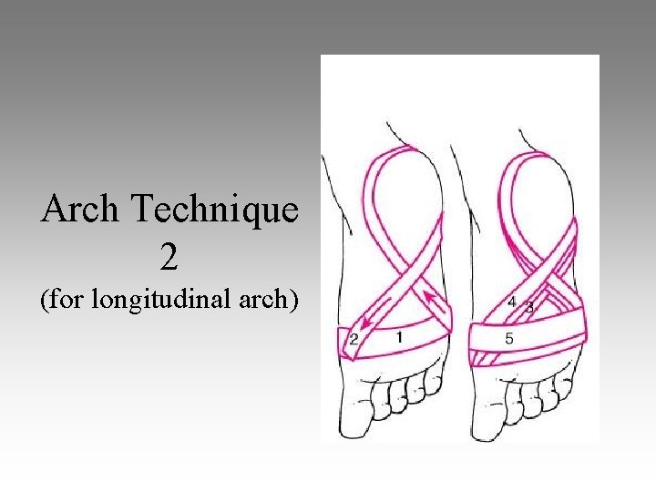 Arch Technique 2 (for longitudinal arch) 