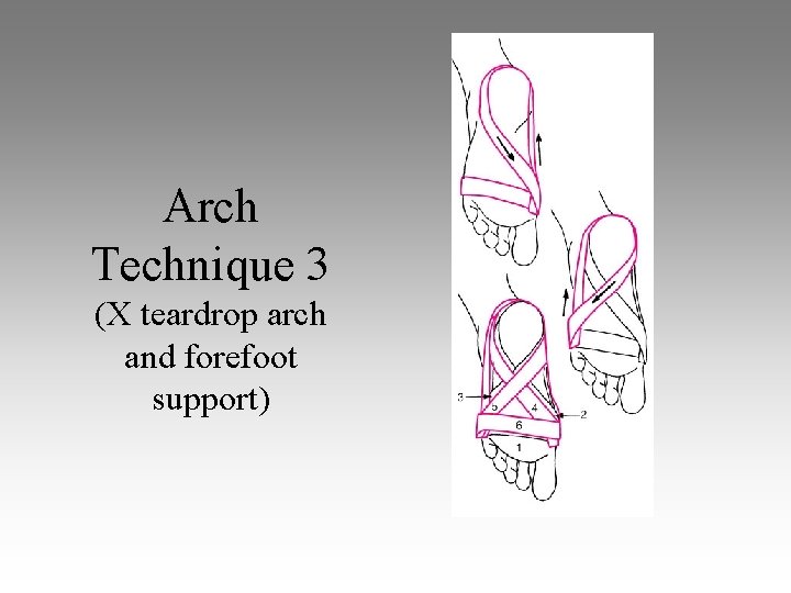 Arch Technique 3 (X teardrop arch and forefoot support) 