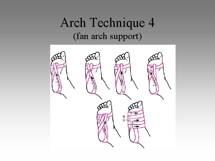 Arch Technique 4 (fan arch support) 