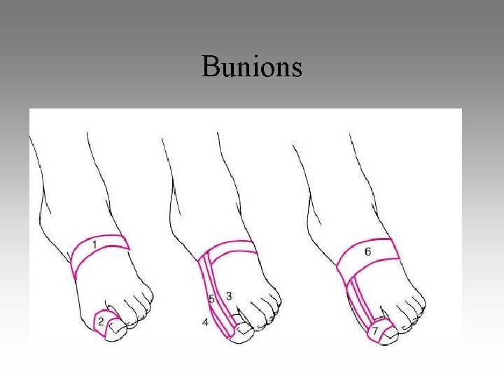 Bunions 