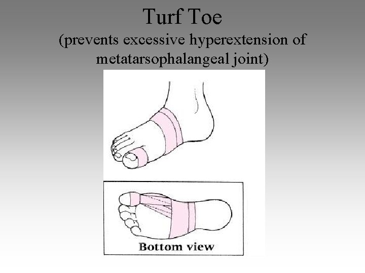 Turf Toe (prevents excessive hyperextension of metatarsophalangeal joint) 