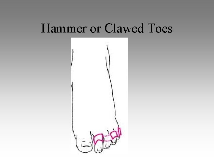 Hammer or Clawed Toes 