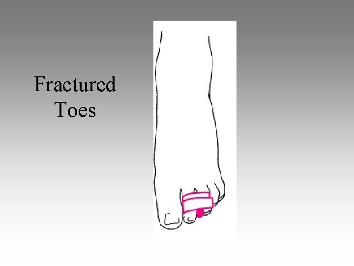 Fractured Toes 
