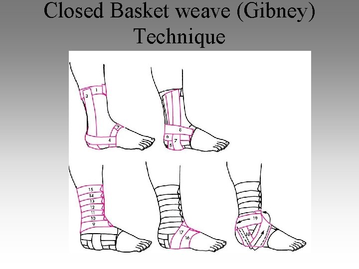 Closed Basket weave (Gibney) Technique 