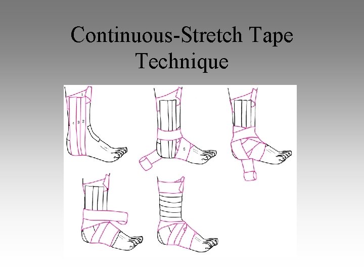 Continuous-Stretch Tape Technique 