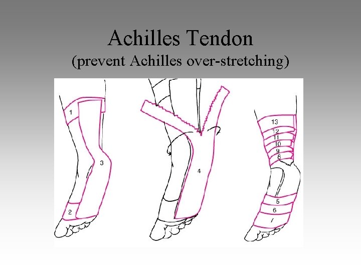 Achilles Tendon (prevent Achilles over-stretching) 