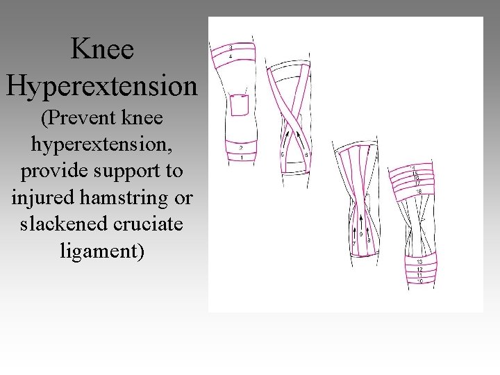 Knee Hyperextension (Prevent knee hyperextension, provide support to injured hamstring or slackened cruciate ligament)