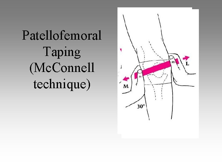 Patellofemoral Taping (Mc. Connell technique) 