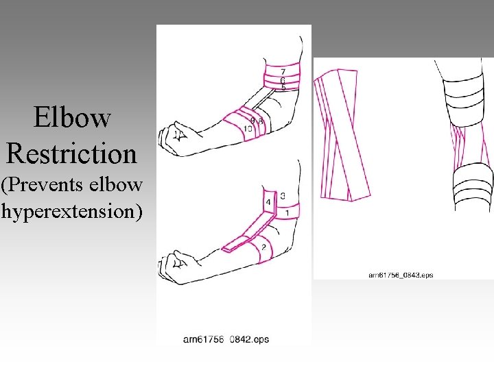 Elbow Restriction (Prevents elbow hyperextension) 