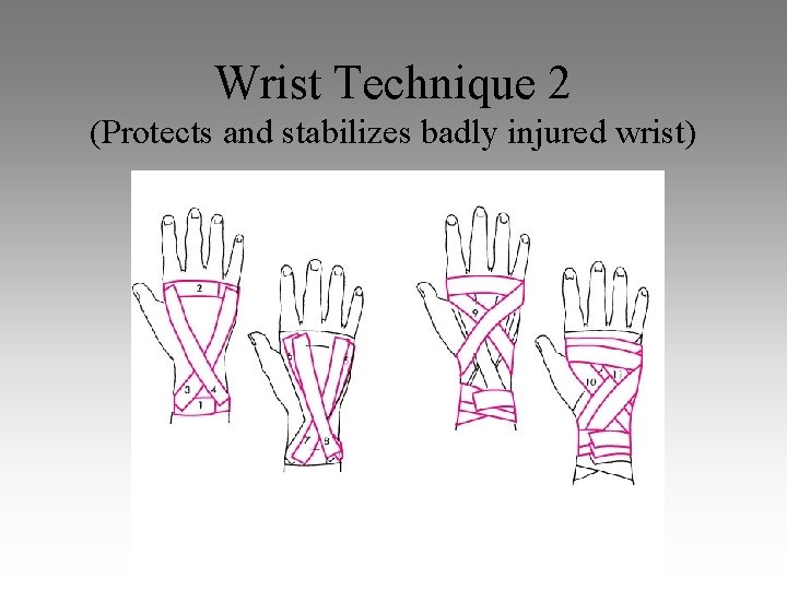 Wrist Technique 2 (Protects and stabilizes badly injured wrist) 