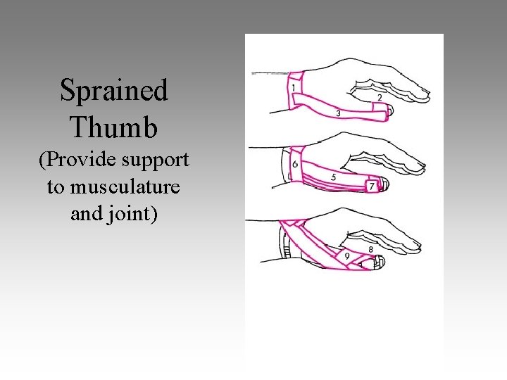 Sprained Thumb (Provide support to musculature and joint) 