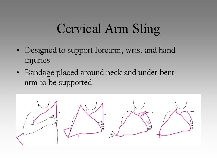 Cervical Arm Sling • Designed to support forearm, wrist and hand injuries • Bandage