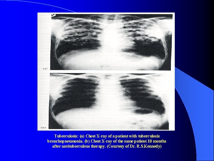 Tuberculosis: (a) Chest X-ray of a patient with tuberculosis bronchopneumonia. (b) Chest X-ray of