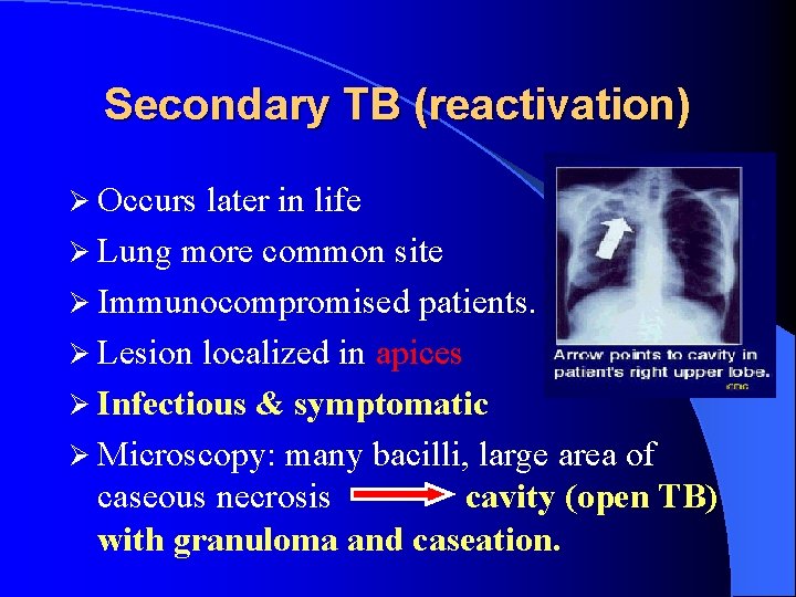 Secondary TB (reactivation) Ø Occurs later in life Ø Lung more common site Ø