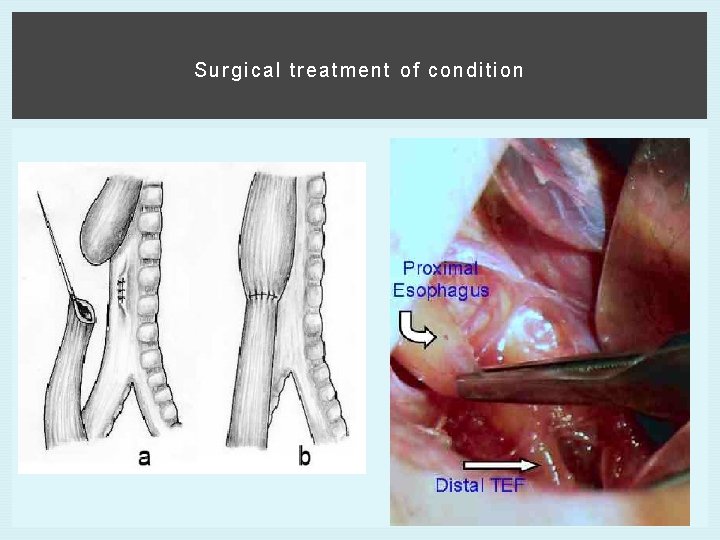 Surgical treatment of condition 
