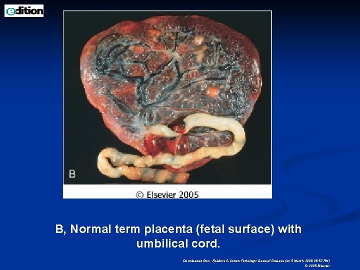 B, Normal term placenta (fetal surface) with umbilical cord. Downloaded from: Robbins & Cotran