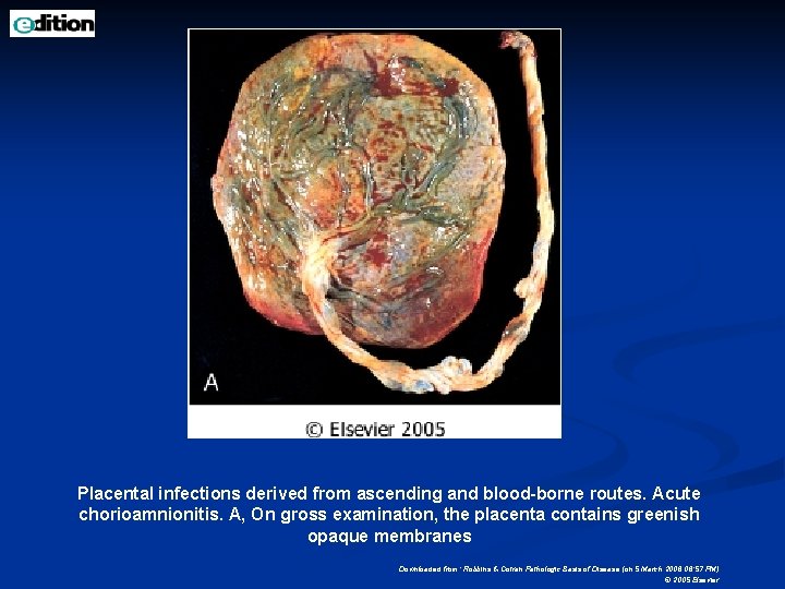 Placental infections derived from ascending and blood-borne routes. Acute chorioamnionitis. A, On gross examination,