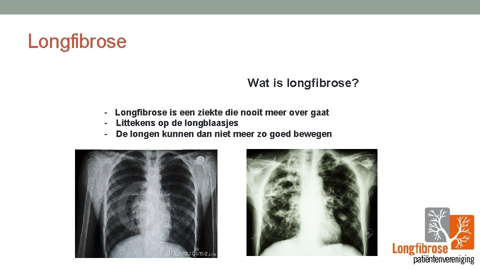 Longfibrose Wat is longfibrose? - Longfibrose is een ziekte die nooit meer over gaat