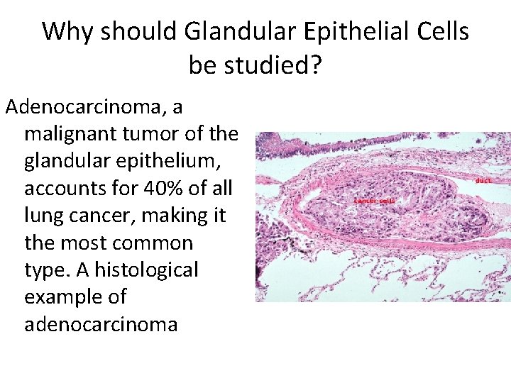Why should Glandular Epithelial Cells be studied? Adenocarcinoma, a malignant tumor of the glandular