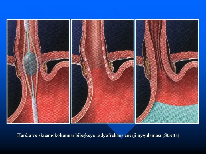 Kardia ve skuamokolumnar bileşkeye radyofrekans enerji uygulaması (Stretta) 